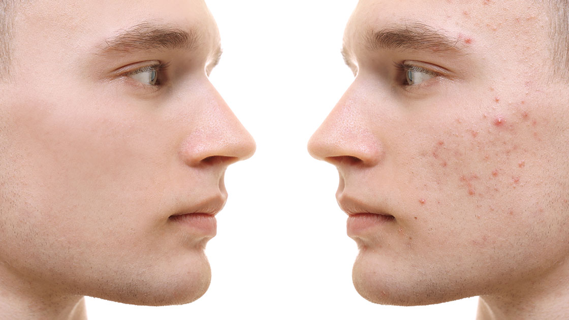 Banish Acne for Good Discover the Power of Laser Therapy!