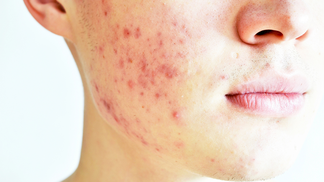 Transform Your Skin with Laser Therapy for Rosacea Relief